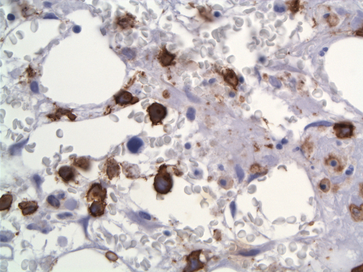 CD30 labels the neoplastic cells with membranous and Golgi pattern